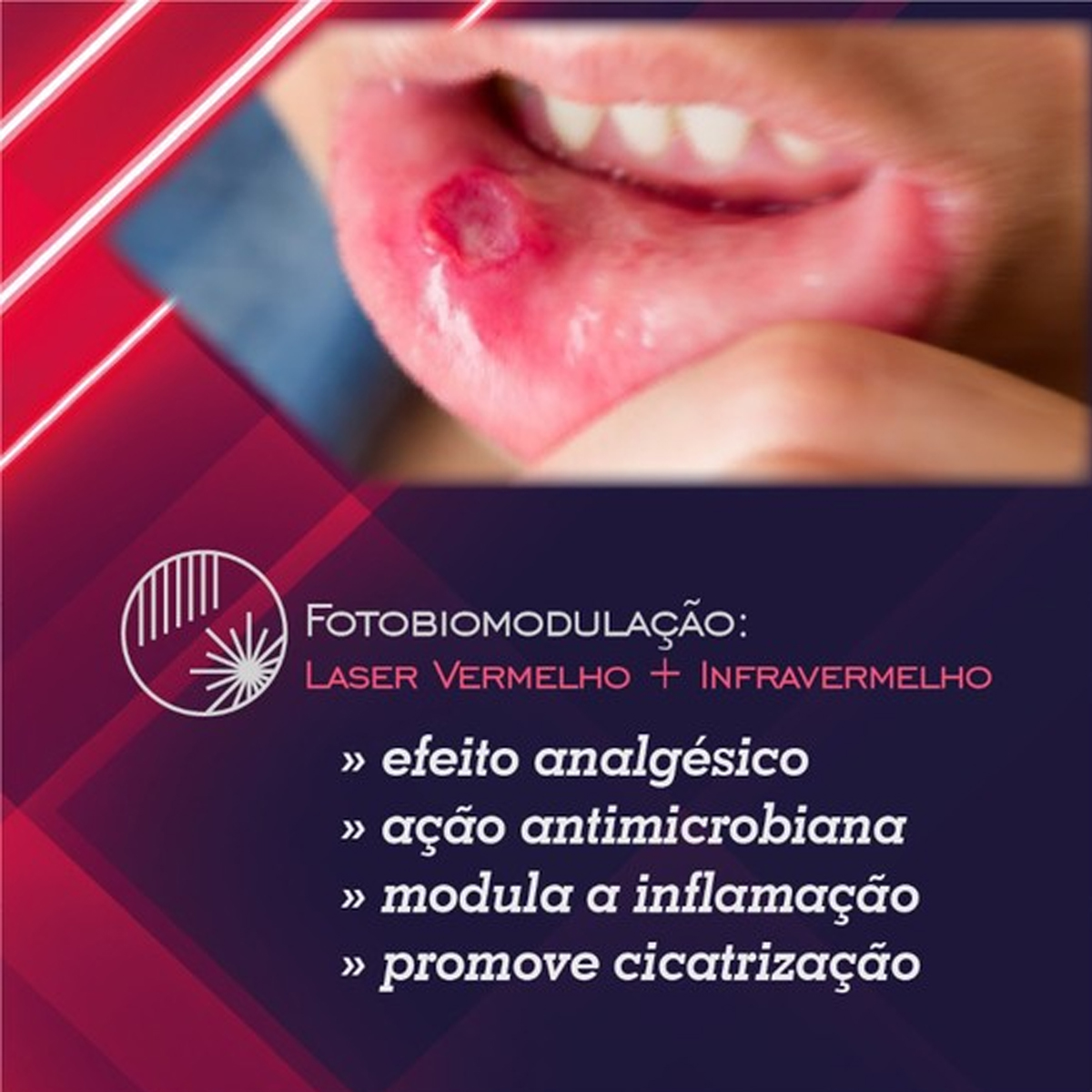 Laser Duo Laserterapia Portátil 660nm e 808nm MMO