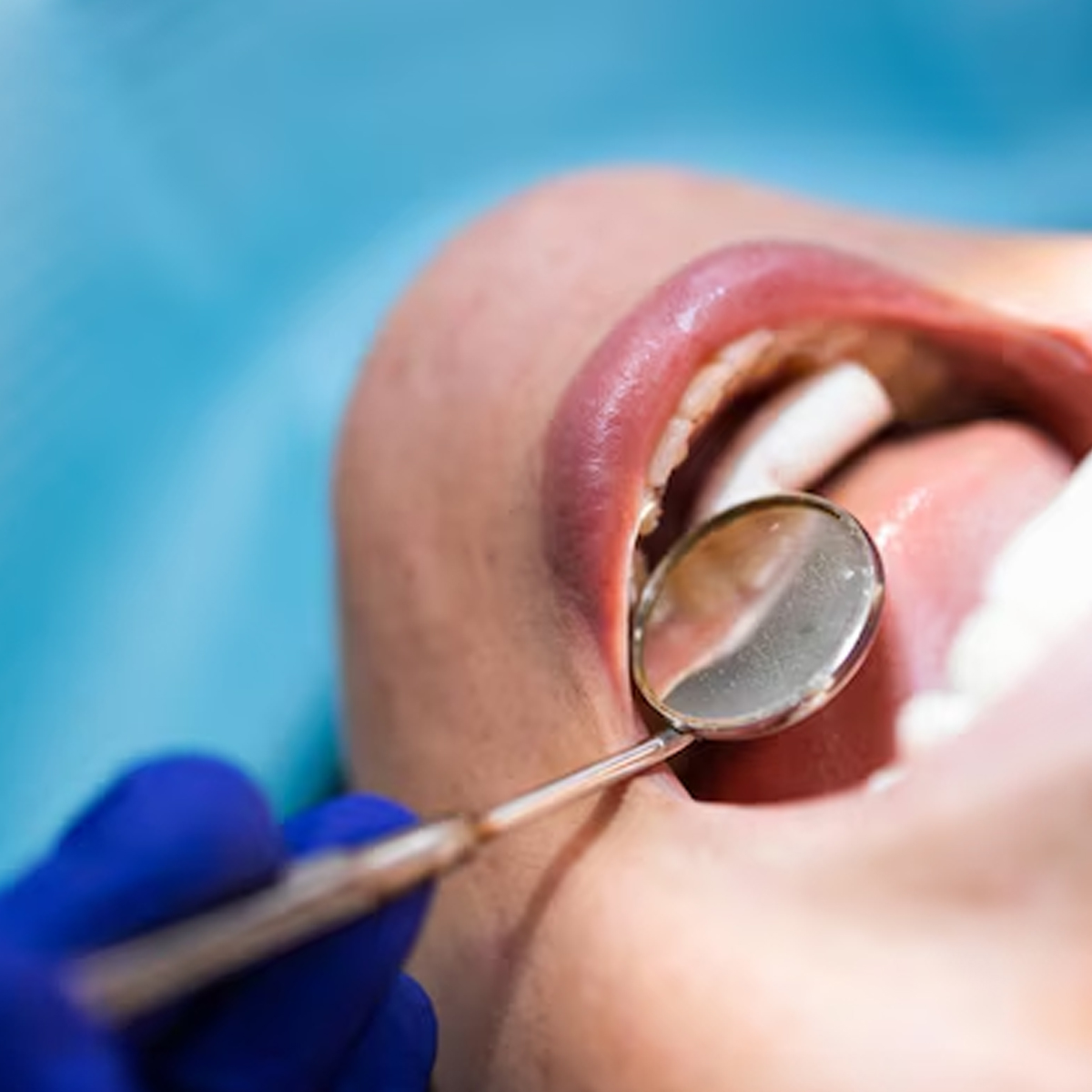 Rolo Dental de Algodão 100und Rolete Max Clean