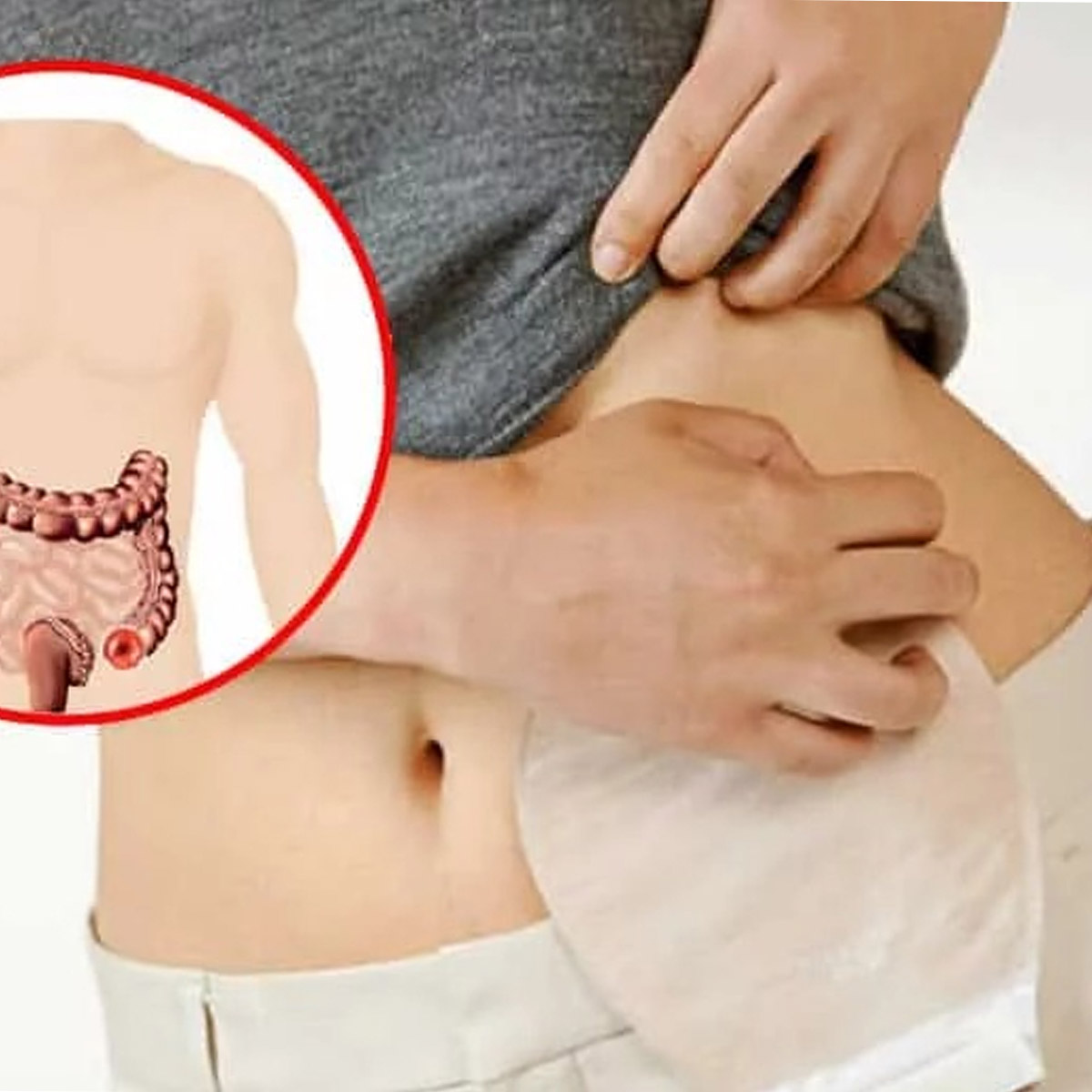 Bolsa Colostomia Adulto Recortável 13MM/64MM Opaca 1Und Casex